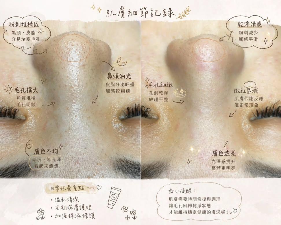 肌愈毛孔護理